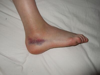 Sprained foot.jpg